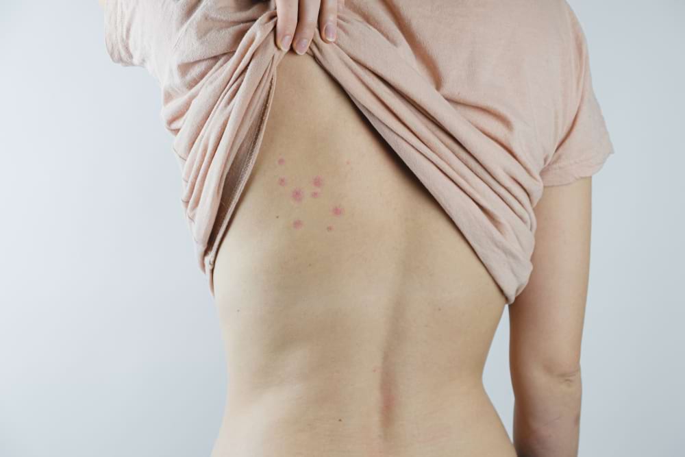 photo of woman's bare back with signs of bedbug bites on it